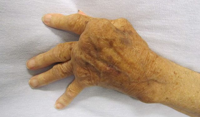 Лечение ревматоидного артрита аппаратом Экосвет1