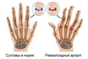 Ревматоидный артрит. Лечение ультрафиолетом