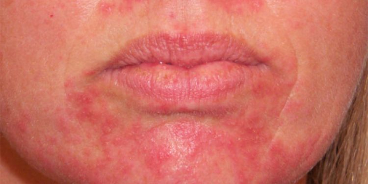 Лечение рожистых заболеваний. «Экосвет1» — надежный заслон инфекционным заболеваниям.